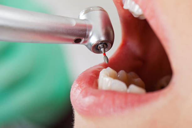 Best Emergency Root Canal Treatment in Fort Belvoir, VA